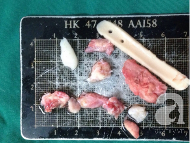Ham nâng mũi cao Tây bất chấp, nhiều phụ nữ Việt gánh hậu quả nặng nề - Ảnh 3. Ham nâng mũi cao Tây bất chấp, nhiều phụ nữ Việt gánh hậu quả nặng nề - Ảnh 3.
