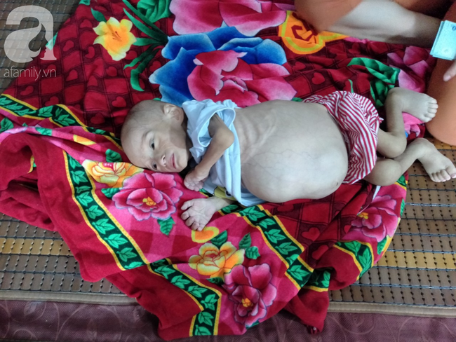 Trên 220 triệu đồng đến với bé trai 1 tuổi, nặng 6kg, cái bụng chực nổ tung vì bệnh u gan mà mẹ nghèo không tiền chữa trị - Ảnh 2.