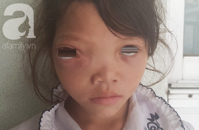 Bé gái 7 năm trời chịu đựng khối u hiểm ác xâm lấn lên não, cướp mất ánh sáng - Ảnh 2.