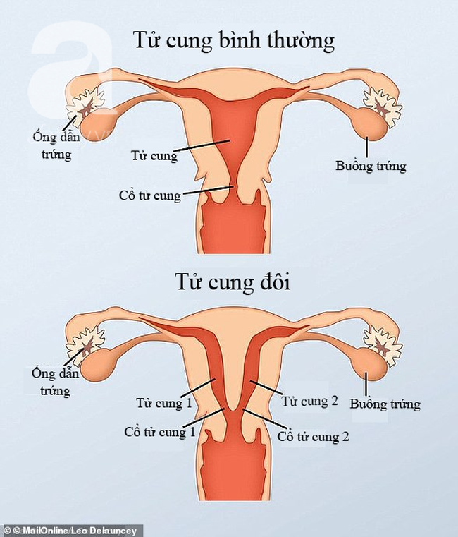 11530044-7369077-When_the_female_foetus_is_developing_two_tubes_normally_join_to_-a-31_1566142551400 copy