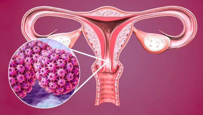 Bác sĩ mách chị em phụ nữ cách đúng nhất để biết mình có đang bị ung thư cổ tử cung hay không - Ảnh 1.