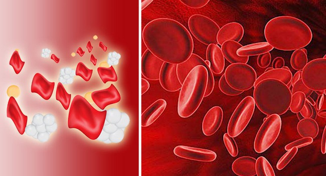 Truyền máu trong và sau khi phẫu thuật cứu bệnh nhi bị viêm phúc mạc ruột thừa trên cơ địa Thalassemia thiếu máu rất nặng - Ảnh 1.