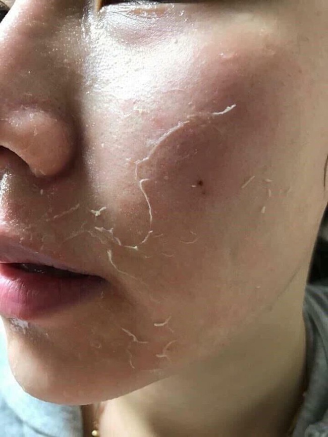 Peel da đón Tết: Chị em cần ghim lại những khuyến cáo sau từ bác sĩ da liễu trước khi làm! - Ảnh 6. Peel da đón Tết: Chị em cần ghim lại những khuyến cáo sau từ bác sĩ da liễu trước khi làm! - Ảnh 6.