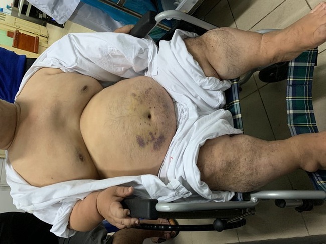 Bệnh viện Hữu nghị Việt Đức lần đầu phẫu thuật bắc cầu động mạch vành cho người bệnh lùn bẩm sinh nhưng cân nặng tới 60kg - Ảnh 1.