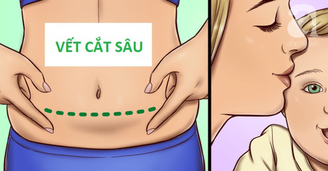 Sinh mổ và toàn bộ những kiến thức cơ bản mẹ cần biết về cuộc đại phẫu: nhiễm trùng, đau đớn, chậm sữa - Ảnh 2. Sinh mổ và toàn bộ những kiến thức cơ bản mẹ cần biết về cuộc đại phẫu: nhiễm trùng, đau đớn, chậm sữa - Ảnh 2.