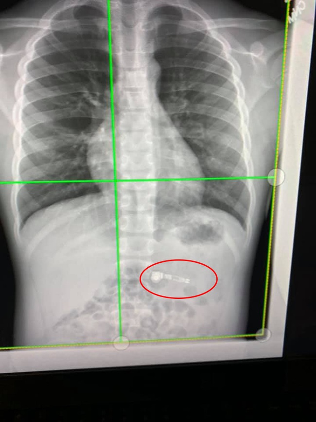 Ngậm tai nghe không dây AirPods trong miệng, rồi vô tình nuốt luôn vào bụng, bé trai 7 tuổi đã phải đi cấp cứu trong bệnh viện - Ảnh 1.
