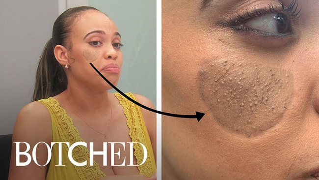 Tai nạn thẩm mỹ kinh khủng nhất với phụ nữ, cấy ghép da vùng kín lên mặt, bị lông mọc ngược - Ảnh 1.