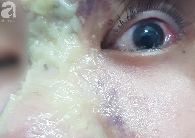 Nhẹ dạ đi tiêm filler nâng mũi tại spa trôi nổi, thiếu nữ 15 tuổi bị mù vĩnh viễn mắt trái ngày cận Tết - Ảnh 2.