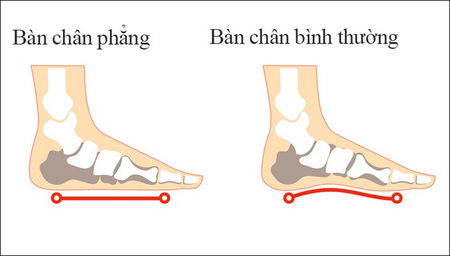 Chân cong sinh lý là hiện tượng bình thường ở trẻ sơ sinh, nhưng cha mẹ cũng nên lưu ý bởi nó cũng có thể là dấu hiệu của một bệnh lý tiềm ẩn - Ảnh 2.