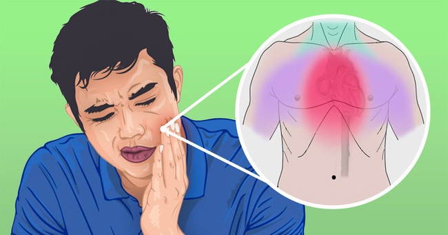 5 cơn đau khó hiểu có thể dễ bị nhầm lẫn với đau răng nhưng lại là những căn bệnh nguy hiểm - Ảnh 3.