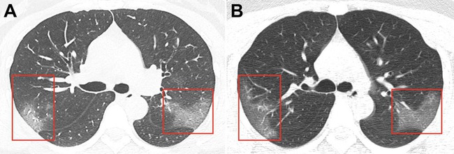 Chụp X-quang phổi cho bệnh nhân 33 tuổi nhiễm virus corona, bác sĩ rùng mình phát hiện hình ảnh tương đồng dịch bệnh trong quá khứ - Ảnh 1.
