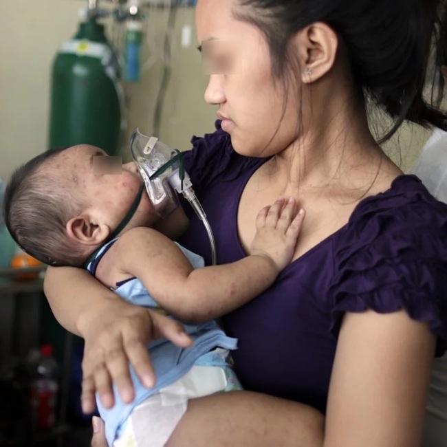 Mẹ anti vắc xin, bé 7 tháng tuổi bị lở loét đầy mủ, nguy kịch vì nhiễm trùng huyết - Ảnh 1.