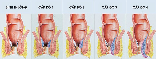 Chàng trai 20 tuổi, cứ 2 tiếng thay “băng vệ sinh” một lần, bác sĩ cảnh báo căn bệnh không chữa kịp nguy hiểm hơn ung thư - Ảnh 4.