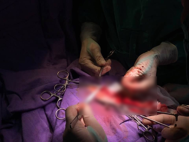 Quảng Ninh: Phẫu thuật ghép sọ não thành công cho bé trai 37 ngày tuổi - Ảnh 2.