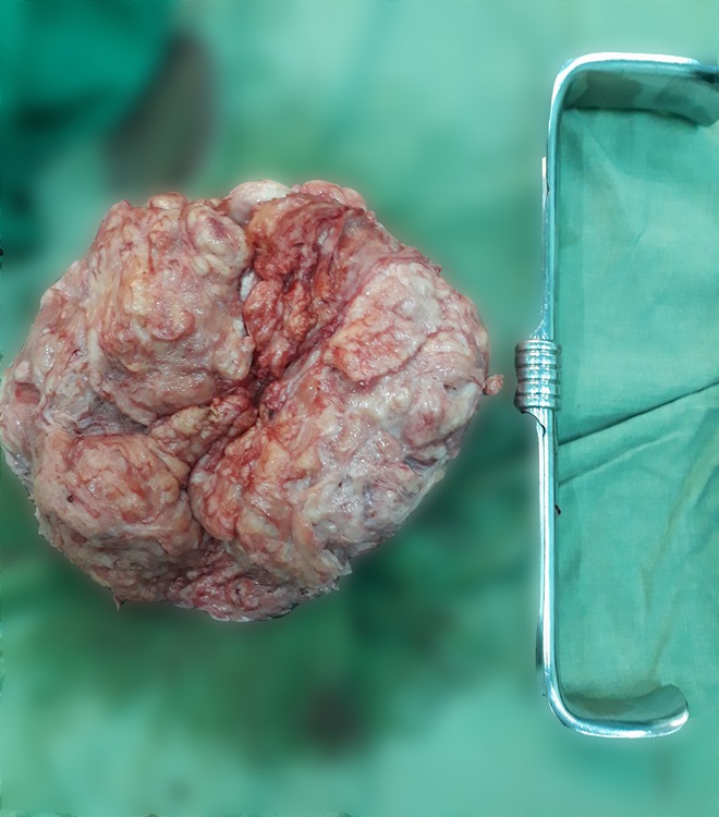 Người phụ nữ có bụng to như mang bầu, bác sĩ phẫu thuật mới phát hiện khối u khủng - Ảnh 1.