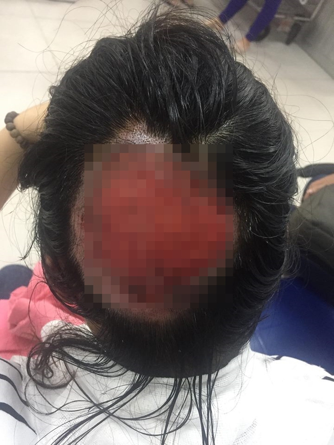 Tai nạn nghiêm khi uốn tóc: Tóc cuốn vào ống dẫn nhiệt, nữ bác sĩ bỏng sâu, tróc gần toàn bộ da đầu phía sau - Ảnh 1.