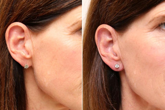 Hết tiêm căng da mặt, chị em còn tiêm filler vào thùy tai để loại bỏ tình trạng chảy xệ của lỗ bấm khuyên - Ảnh 1.