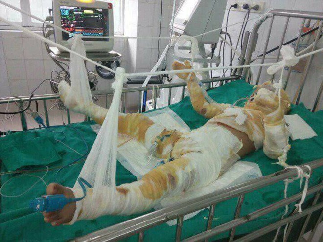Xót xa hoàn cảnh bé trai sang hàng xóm xem nướng mực bị cồn thiêu như đuốc, hoại tử 2 chân - Ảnh 1. Xót xa hoàn cảnh bé trai sang hàng xóm xem nướng mực bị cồn thiêu như đuốc, hoại tử 2 chân - Ảnh 1.