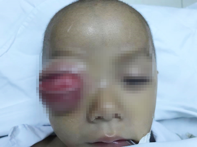 TP.HCM: Mẹ chủ quan không điều trị đầy đủ viêm xoang ở mũi cho con, bé trai 16 tháng tuổi suýt mù mắt phải - Ảnh 1.