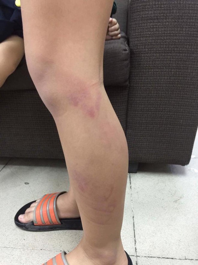 Hà Nội: Học sinh vào lớp chậm cô giáo đánh tím tái hai chân đến khi gãy thước ? - Ảnh 2. Hà Nội: Học sinh vào lớp chậm cô giáo đánh tím tái hai chân đến khi gãy thước ? - Ảnh 2.