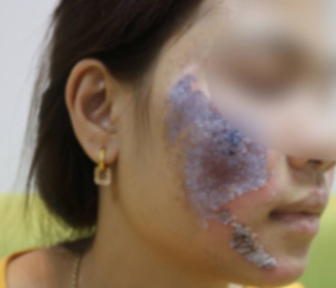 Hà Nội: Dùng kem trộn, một phụ nữ bị lột sạch da mặt, mất hàng trăm triệu điều trị nhưng chỉ phục hồi được 30-40% - Ảnh 2.
