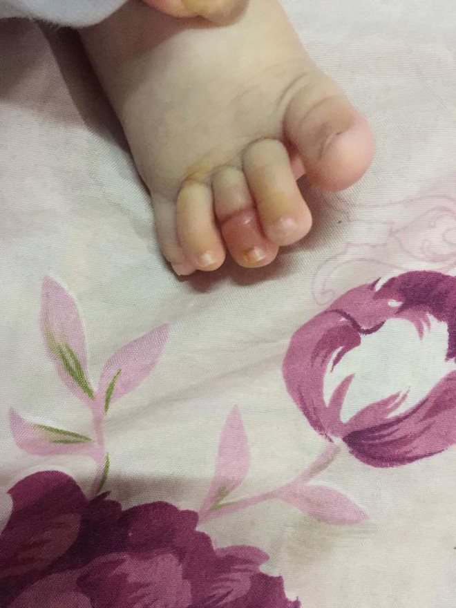 Ngón chân bé trai 2 tháng tuổi bị hoại tử, có nguy cơ phải cắt bỏ chì vì 1 sợi tóc vương vãi - Ảnh 3.