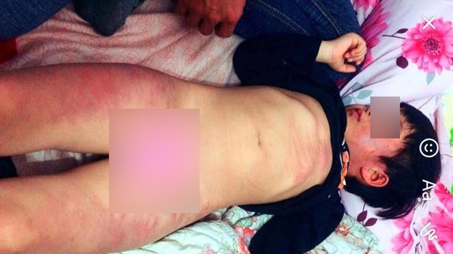 Bắc Giang: Gia đình tố cô giáo đánh con bầm tím toàn thân khi đi học ở trường - Ảnh 4.