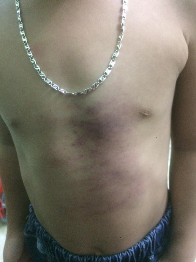 Bắc Giang: Gia đình tố cô giáo đánh con bầm tím toàn thân khi đi học ở trường - Ảnh 2.