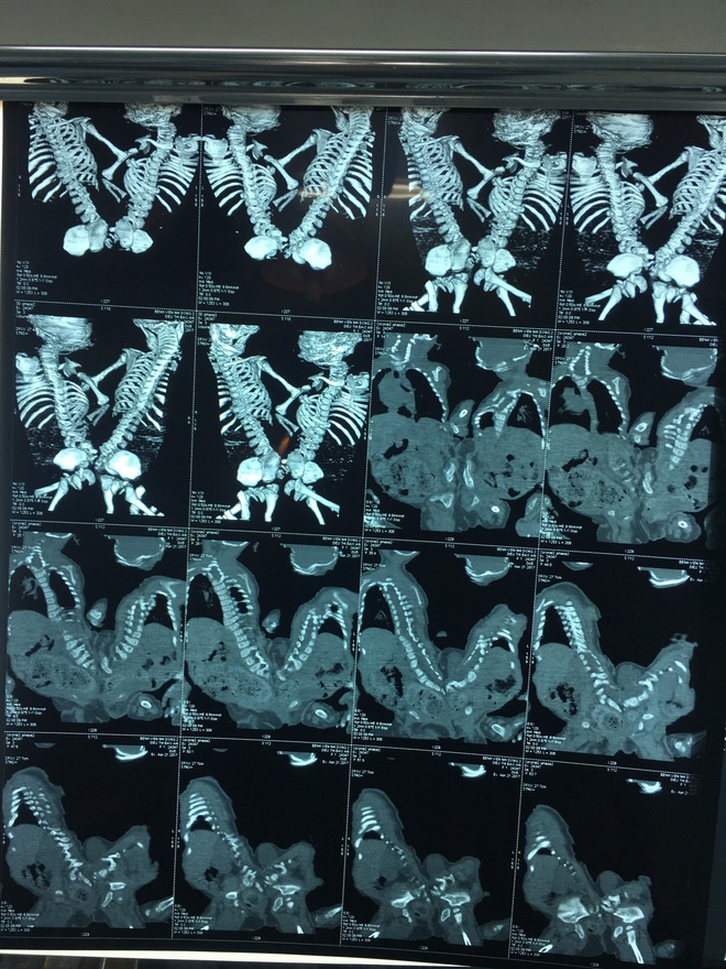 Lần đầu tiên sau năm 1975, Việt Nam xuất hiện hai bé gái song sinh dính nhau vùng cùng cụt - Ảnh 2.