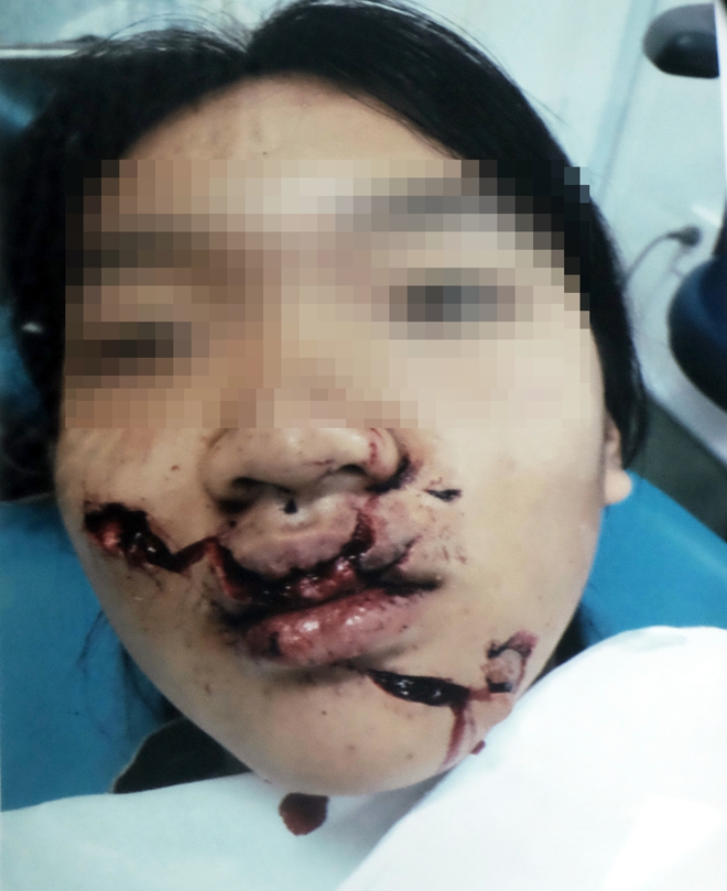 Ngã vào kính trường học trong ngày hành kinh, bé gái 11 tuổi bị huỷ hoại khuôn mặt nặng nề - Ảnh 3.