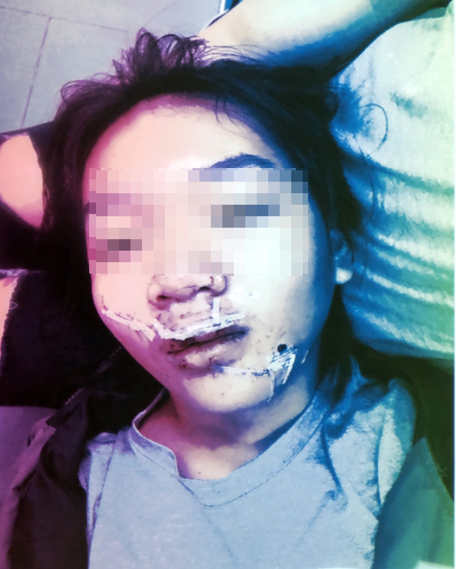 Ngã vào kính trường học trong ngày hành kinh, bé gái 11 tuổi bị huỷ hoại khuôn mặt nặng nề - Ảnh 5.