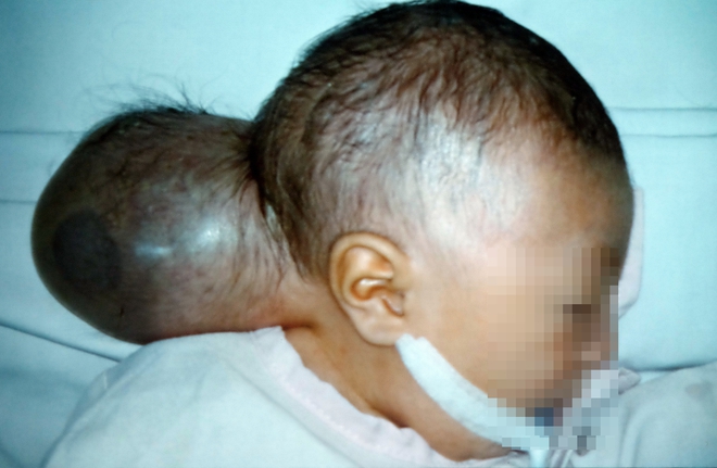 Bé gái mang khối u quái dị trông như có 2 đầu bị mẹ bỏ rơi khi đưa đến bệnh viện một ngày - Ảnh 2.