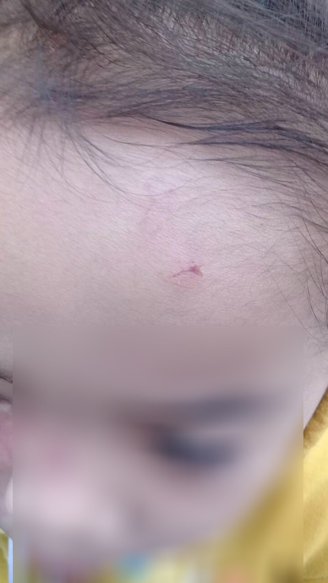 Bé gái 4 tuổi bị bạo hành ở Mầm Xanh tiếp tục có dấu hiệu bị đánh đập ở cơ sở giữ trẻ mới - Ảnh 5.