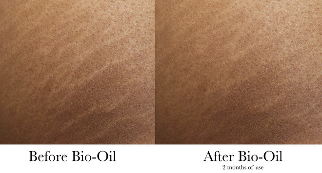 Nghe đồn thổi đã nhiều về loại dầu chống rạn da - Bio Oil , nhưng bạn đã biết phải sử dụng sao cho đúng - Ảnh 7.