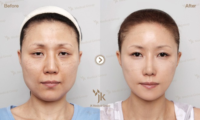 Sau hạ gò má thì phương pháp lấp đầy râu rồng sẽ giúp các chị em trẻ ra vài chục tuổi - Ảnh 12. Sau hạ gò má thì phương pháp lấp đầy râu rồng sẽ giúp các chị em trẻ ra vài chục tuổi - Ảnh 12.