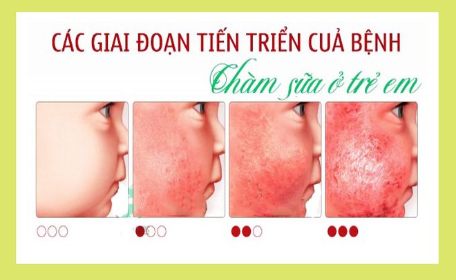 Những tưởng con mắc 4 chứng bệnh về da nhưng sau cùng mẹ thở phào vì bé chỉ bị loại mụn nhẹ này thôi - Ảnh 2.