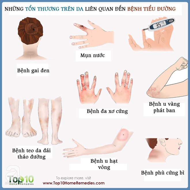 Những tổn thương trên da liên quan đến bệnh tiểu đường: Nhìn là nhận ra ngay - Ảnh 2. Những tổn thương trên da liên quan đến bệnh tiểu đường: Nhìn là nhận ra ngay - Ảnh 2.