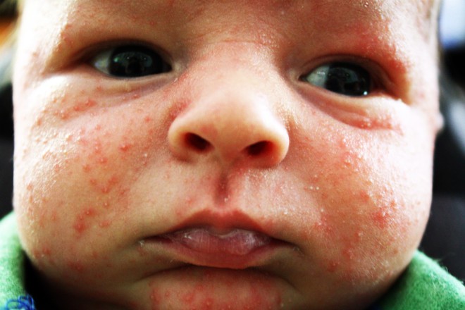Những tưởng con mắc 4 chứng bệnh về da nhưng sau cùng mẹ thở phào vì bé chỉ bị loại mụn nhẹ này thôi - Ảnh 4.