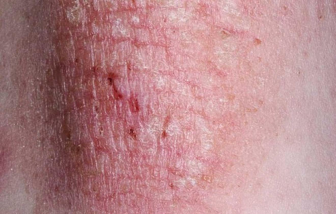 3 bệnh phổ biến ở da mà chị em nào cũng sợ gặp phải và cách xử lý để có làn da khỏe mạnh, xinh đẹp - Ảnh 3.