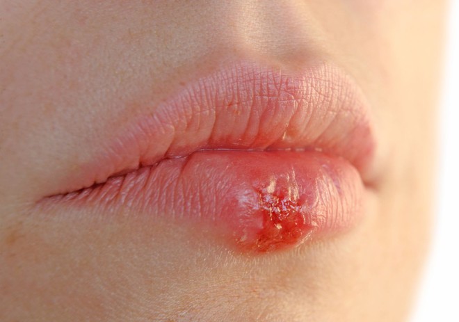 Những sự thật bạn chưa biết về bệnh Herpes, đọc đi nếu không muốn sợ hãi với chúng - Ảnh 2.