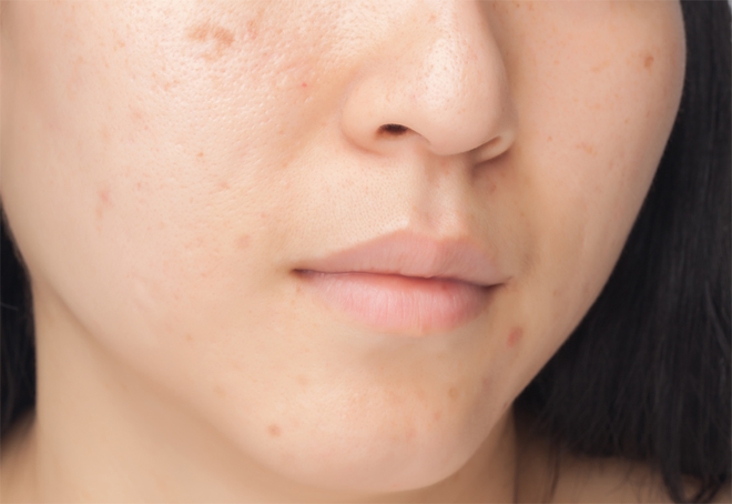 8 sản phẩm trị mụn và sẹo mụn mang lại hiệu quả cấp tốc cho làn da của bạn - Ảnh 1.
