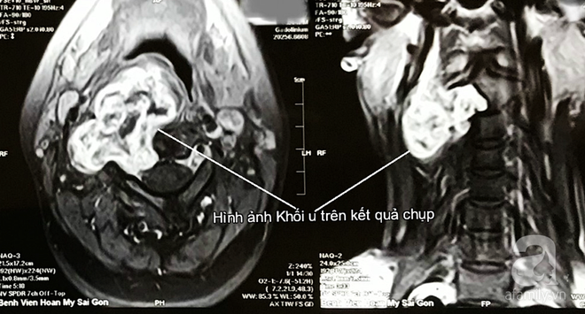 TP.HCM: Cô gái 26 tuổi suýt mất giọng nói vĩnh viễn vì mang khối u đặc biệt nhưng lầm là hạch ở cổ - Ảnh 1.