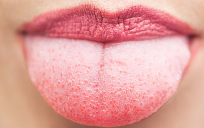 Những nguyên nhân gây nên hiện tượng lưỡi trắng - hóa ra có cả nguyên nhân nguy hiểm không ngờ - Ảnh 1.
