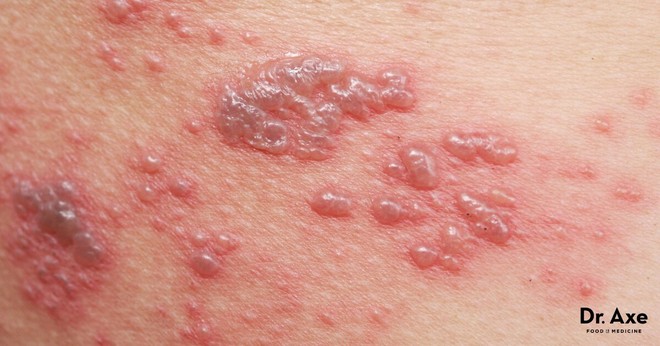 7 nguyên nhân dẫn đến bệnh Lichen phẳng - căn bệnh viêm da không có cách điều trị - Ảnh 2.