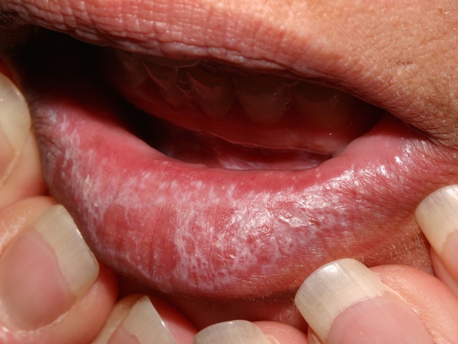 7 nguyên nhân dẫn đến bệnh Lichen phẳng - căn bệnh viêm da không có cách điều trị - Ảnh 3.