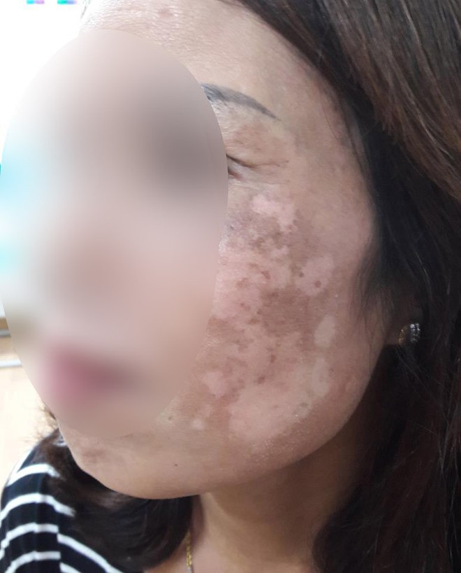 Hà Nội: Dùng kem trộn, một phụ nữ bị lột sạch da mặt, mất hàng trăm triệu điều trị nhưng chỉ phục hồi được 30-40% - Ảnh 1.
