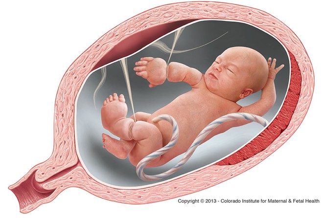 Có 1 hội chứng thai kỳ ít người biết khiến em bé sinh ra không lành lặn thậm chí giết chết thai nhi - Ảnh 1.