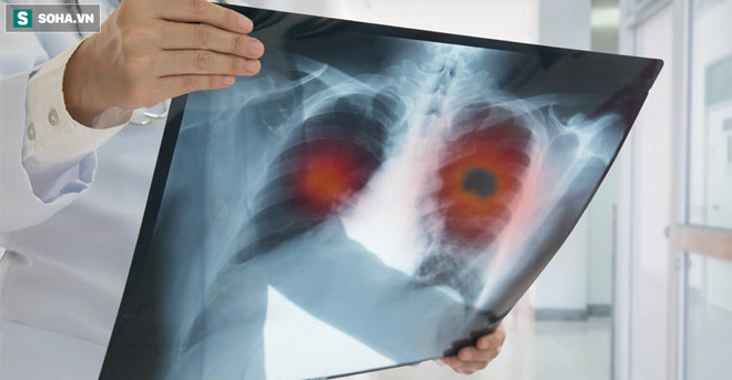 1 triệu chứng cảnh báo ung thư phổi giai đoạn đầu: Phát hiện sớm 90% cơ hội chữa khỏi bệnh - Ảnh 2.
