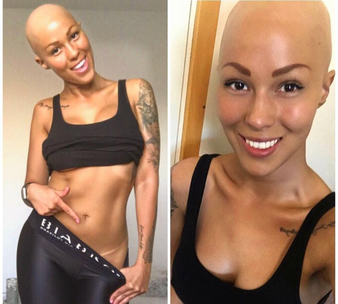 Tưởng mình bị ung thư khi tóc rụng dần, 12 năm sau, cô trở thành một người mẫu xinh đẹp với chiếc đầu trọc lóc - Ảnh 4.