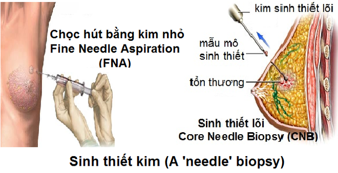 6 xét nghiệm giúp phát hiện sớm ung thư - Ảnh 3.